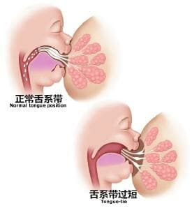 嬰兒吃母乳總漏奶原是“大舌頭”作祟 出生滿月后治療最佳