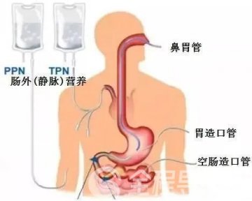 徐州一院重癥醫(yī)學(xué)科：營養(yǎng)治療的重要性，你了解嗎？